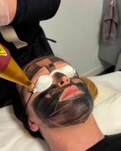 carbon peel montpellier