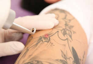 Séance de détatouage